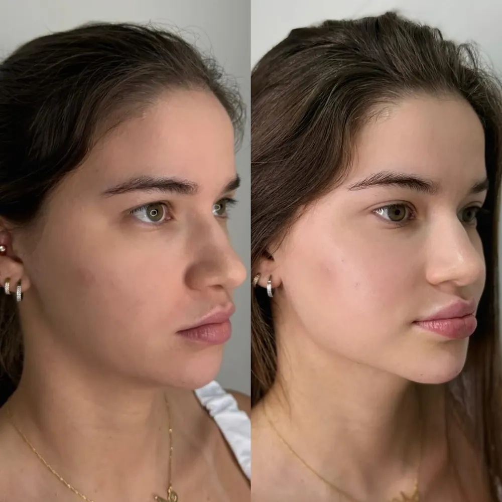Antes e depois de harmonização facial, vista de três quartos