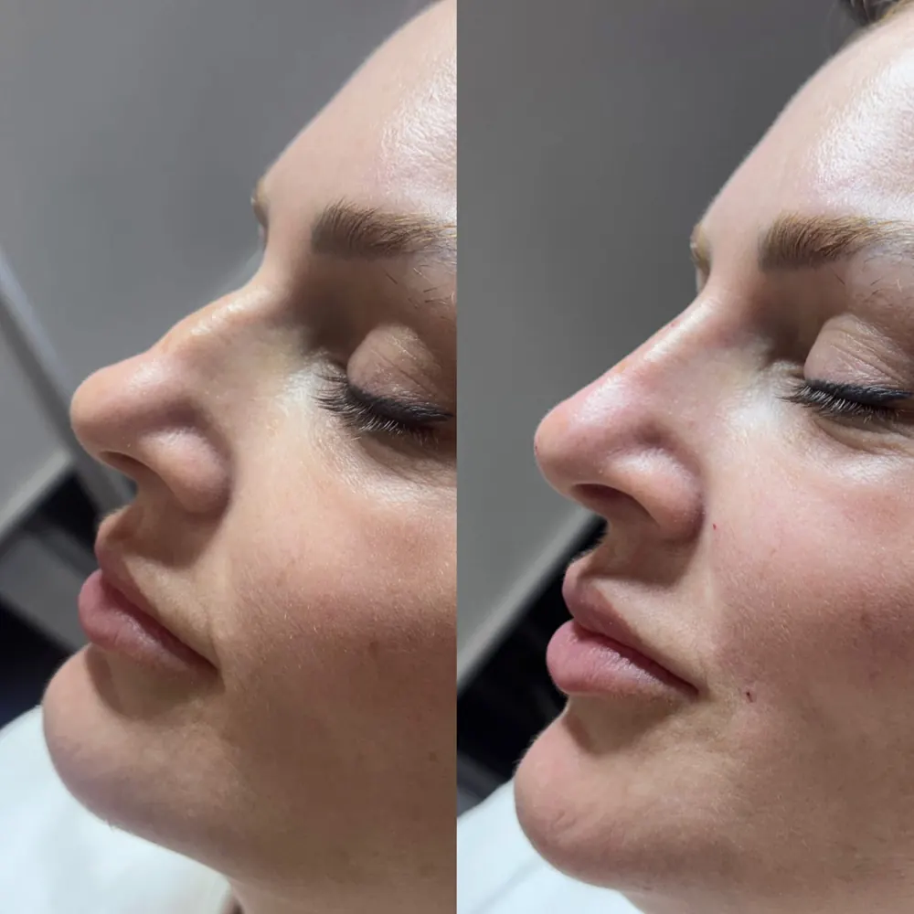 Antes e depois de rinomodelação e lábios, vista de perfil