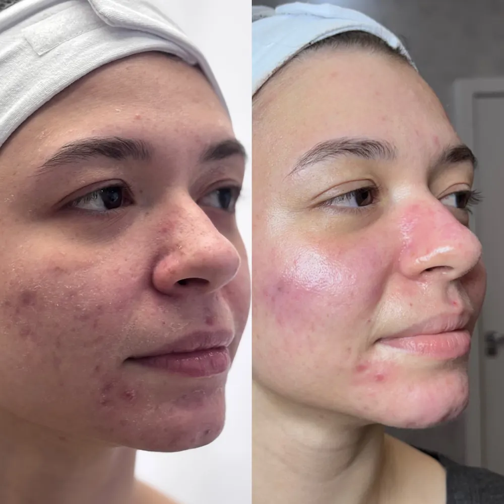 Antes e depois: Logo após a sessão