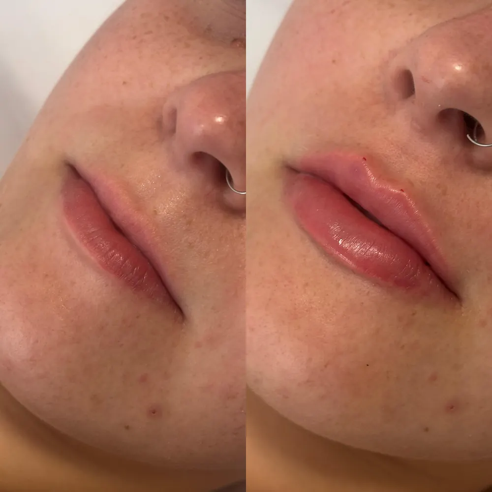 Antes e depois: Preenchimento labial
