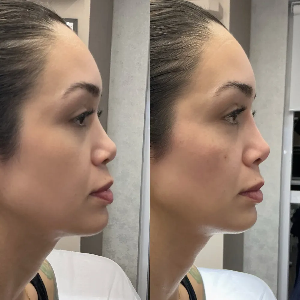 Antes e depois: Queixo e mandíbula