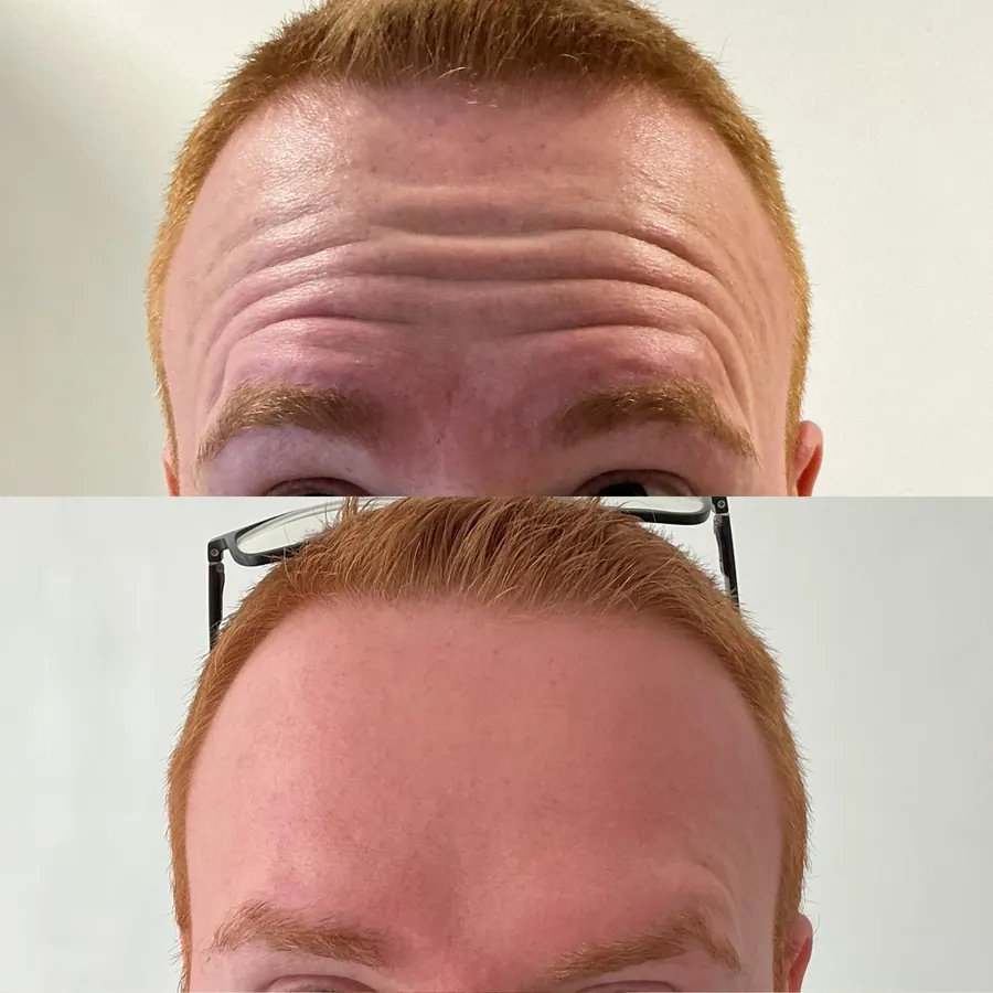 Antes e depois: Testa