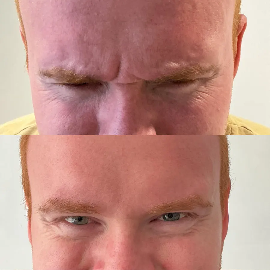 Antes e depois: Olhos e entre as sobrancelhas