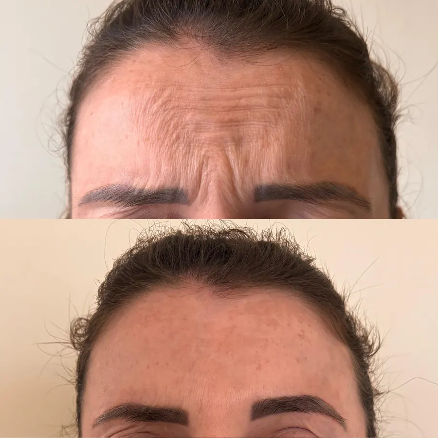 Antes e depois: Testa e entre as sobrancelhas
