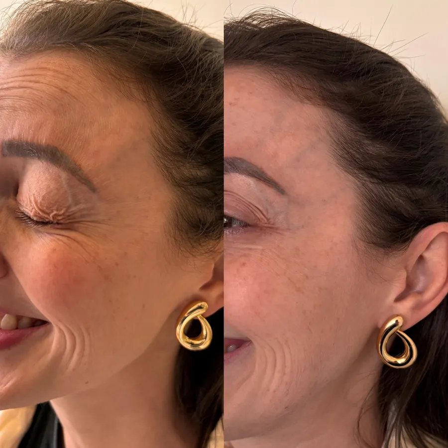 Antes e depois: Ao redor dos olhos