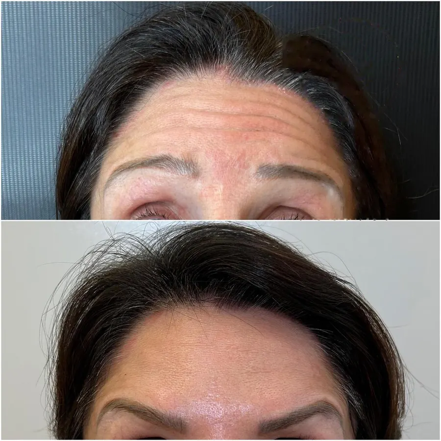 Antes e depois: Testa