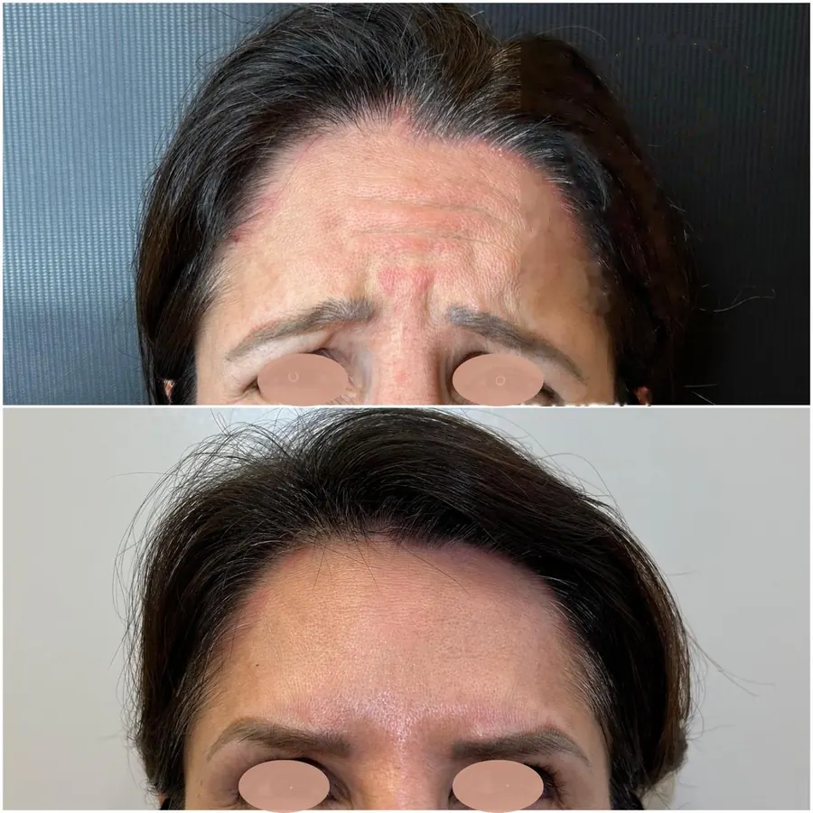 Antes e depois: Entre as sobrancelhas